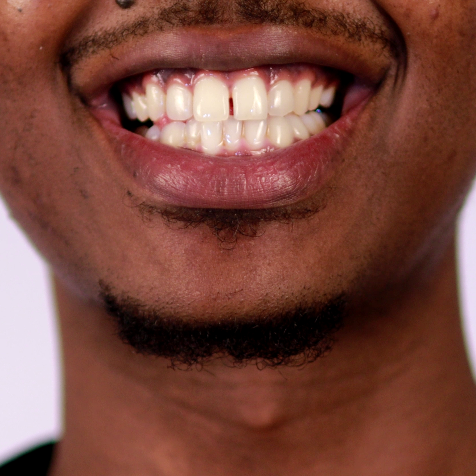 Enjoy a straighter smile with Alidon